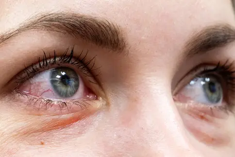 photo of woman with red, irritated eyes